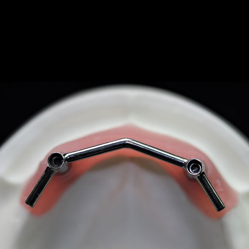 Implant Bar