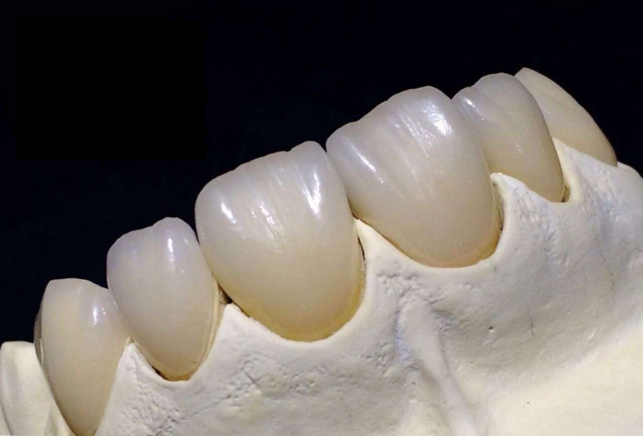 zirconia ကြွေသွားများအကြောင်းသတိထားပါ။