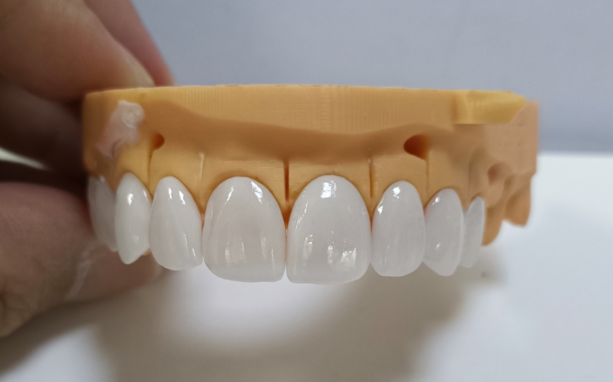မြင့်မားသော Esthetic Emax Veneers