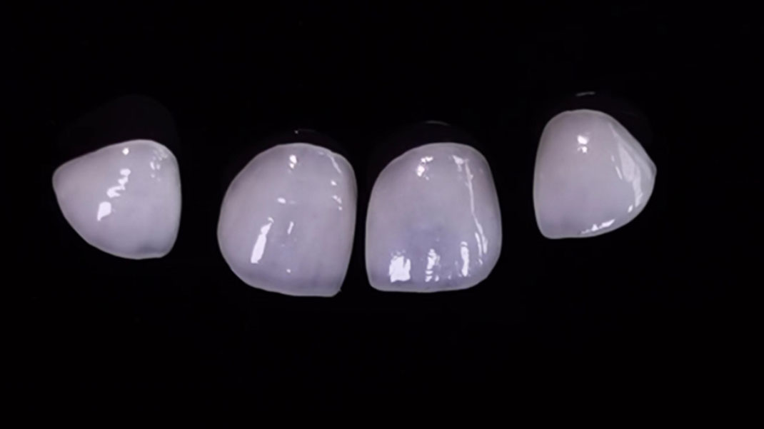 သွားဘက်ဆိုင်ရာ Laminate Veneers