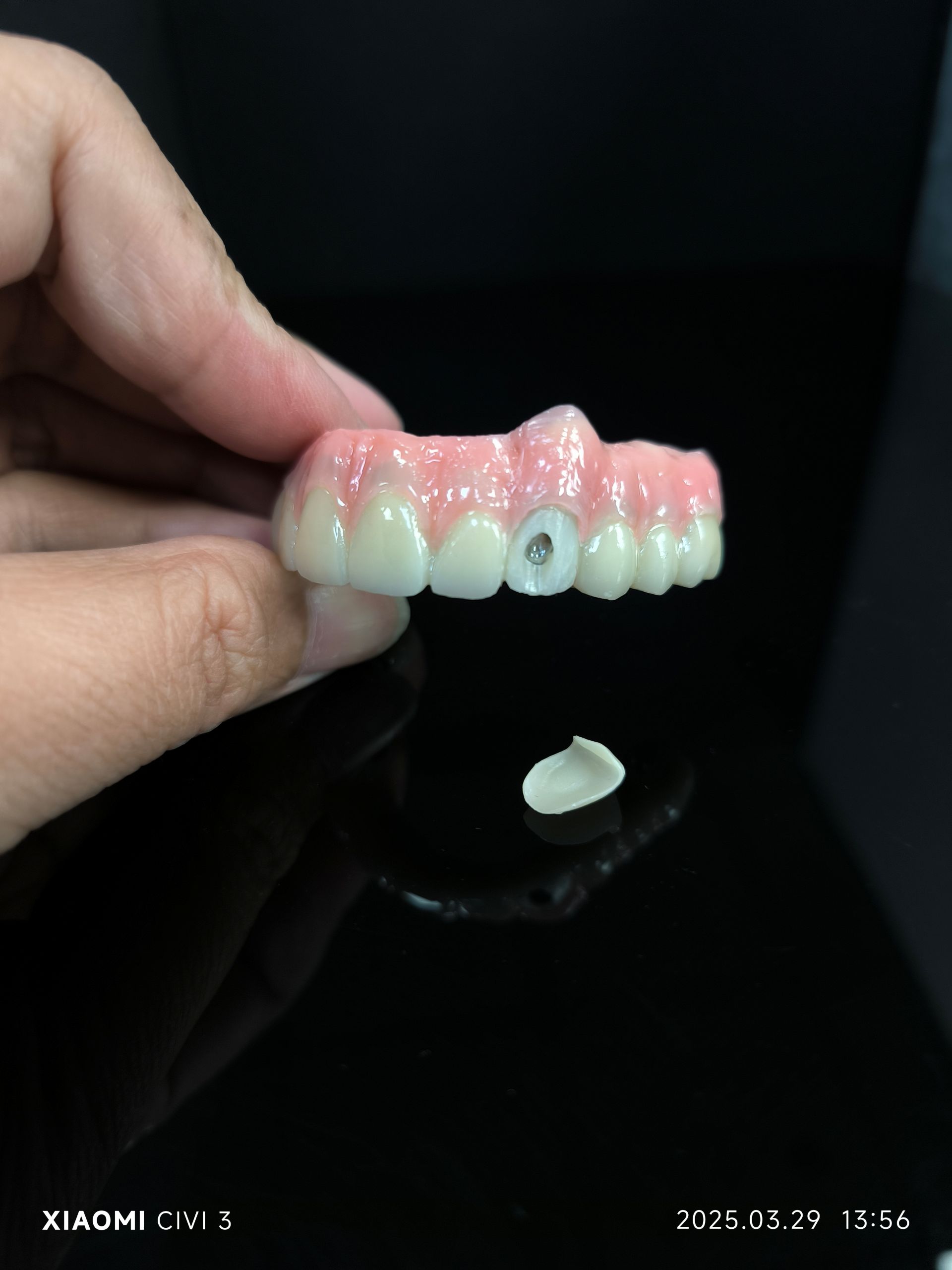 4 - Vestibular ဝက်အူအပေါက်များအတွက်မျိုးစပ် Zirconia တံတားဖြေရှင်းချက်