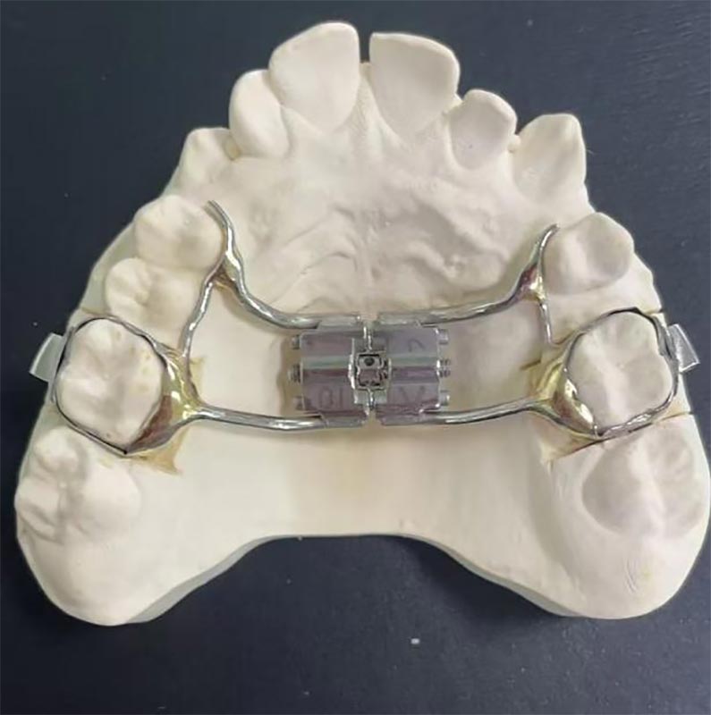 လျင်မြန်စွာ maxillary exprander (RME) ဆိုတာဘာလဲ။