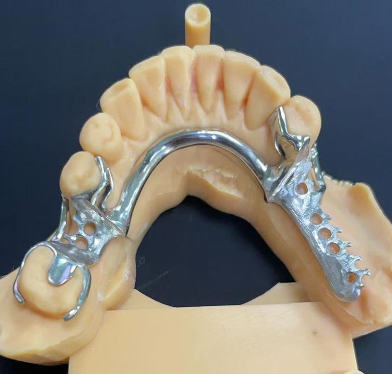 Cobalt-Chromium Framework (Co Cr Framework) ၏ အားသာချက်များ
