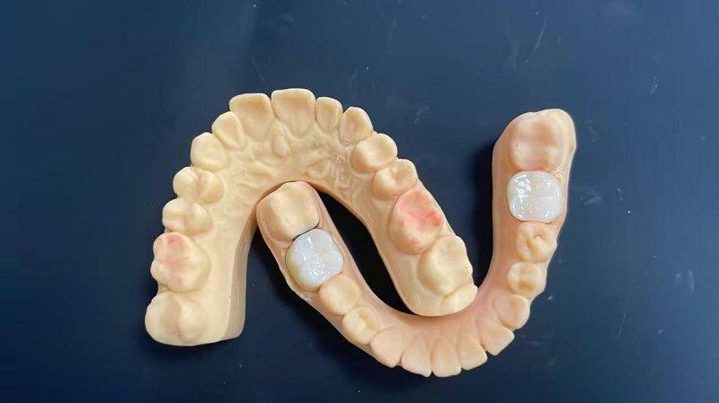 ပခုံးအစွန်းဆိုတာဘာလဲ။