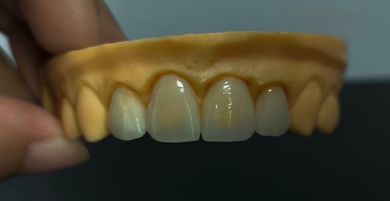 Porcelain Veneers တွေရဲ့ သက်တမ်းက ဘယ်လောက်လဲ။
