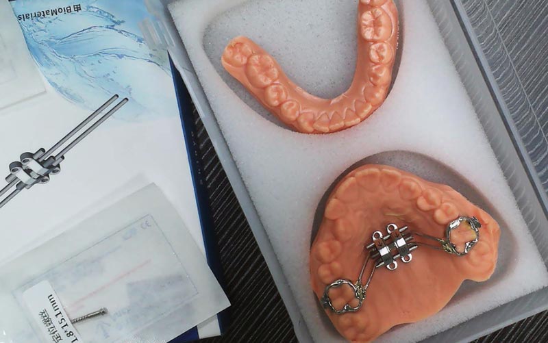 WM Dental Lab ဖြင့် MSE Skeletal Expansion ကို နားလည်ပါ။