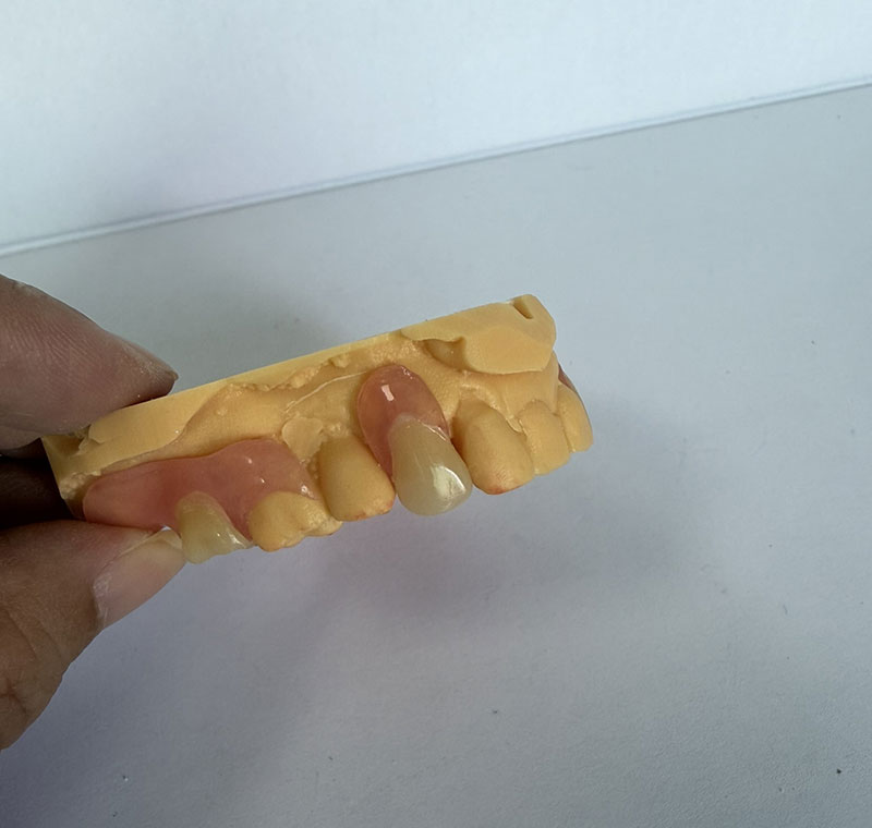 WM Dental Lab တွင် Valplast Partials