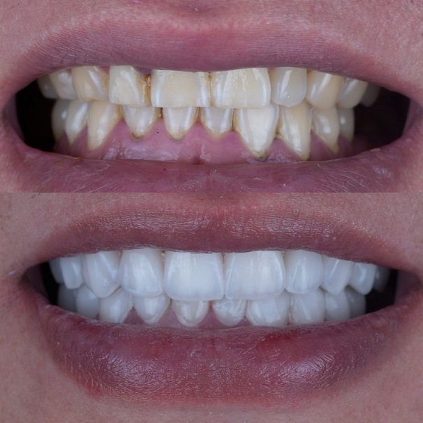 Emax Layered Veneers Esthetic China သွားဘက်ဆိုင်ရာ ဓာတ်ခွဲခန်း