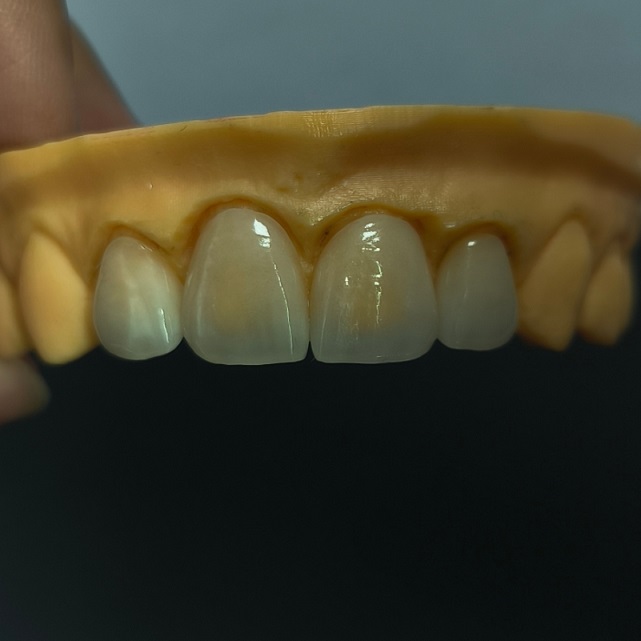 High Translucent သွားဘက်ဆိုင်ရာ Veneers အလွှာ Emax Veneer