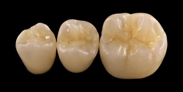 <h2>သွားဘက်ဆိုင်ရာတွင် Zirconia- ညွှန်ပြချက်များ၊ အားသာချက်များနှင့် ဆေးခန်းဆိုင်ရာ ထည့်သွင်းစဉ်းစားမှုများ</h2>
<p>Zirconia သည် ၎င်း၏ ခိုင်ခံ့မှုနှင့် တာရှည်ခံမှုအတွက် ကျယ်ပြန့်စွာ အသိအမှတ်ပြုထားသည်။ နောက်ဆုံးမျိုးဆက် zirconia ပစ္စည်းများသည်လည်း သိသာထင်ရှားစွာ တိုးတက်လာသော အလှအပဆိုင်ရာ ဂုဏ်သတ္တိများကို ပေးဆောင်ပါသည်။ ကြွေထည်အားလုံးကို ပြန်လည်ပြုပြင်ခြင်းများကို စဉ်းစားနေသည့် လူနာများအတွက်၊ zirconia-based စနစ်များ၏ ညွှန်ပြမှုများနှင့် ကန့်သတ်ချက်များကို ဂရုတစိုက် အကဲဖြတ်ရန် လိုအပ်ပါသည်။</p>
<p>ယနေ့ခေတ် လူနာများသည် ကောင်းမွန်သော အလှတရားများ ပေါင်းစပ်လုပ်ဆောင်နိုင်သော စွမ်းဆောင်မှု အပြည့်ဖြင့် ပြန်လည်ထူထောင်ရေးများကို မျှော်လင့်လာကြသည်။ ခေတ်မီကြွေထည်စနစ်အများစုသည် အဆိုပါမျှော်လင့်ချက်များကို ဖြည့်ဆည်းပေးနိုင်သော်လည်း လက်တွေ့အောင်မြင်မှုသည် သင့်လျော်သောပစ္စည်းရွေးချယ်မှု၊ သွားများပြင်ဆင်မှုနှင့် ဘိလပ်မြေလုပ်ထုံးလုပ်နည်းများပေါ်တွင် များစွာမူတည်သည်။ ရွေးချယ်မှုအား အရိုးကျိုးခြင်း ခံနိုင်ရည်၊ ပျော့ပြောင်းမှု ၊ ဝတ်ဆင်မှု ခံနိုင်ရည် နှင့် ရေရှည် တည်ငြိမ်မှု ကဲ့သို့သော အဓိက ပစ္စည်း ဂုဏ်သတ္တိများဖြင့် လမ်းညွှန်သင့်ပါသည်။ ဤပစ္စည်းများထဲတွင် zirconia သည် ခေတ်ပြိုင်သွားဘက်ဆိုင်ရာ ပြန်လည်ပြုပြင်ရေးတွင် အသုံးအများဆုံးရွေးချယ်မှုတစ်ခုဖြစ်လာသည်။</p>
<h3>Zirconia ကို ဘာကြောင့် ရွေးချယ်တာလဲ။</h3>
<p>Zirconia သည် ၎င်း၏ထူးခြားသောအစွမ်းသတ္တိနှင့် ရေရှည်ခံနိုင်ရည်အတွက် တန်ဖိုးရှိသည်။ ခေတ်သစ် zirconia သည် ယခင်က မျိုးဆက်များနှင့် သိသိသာသာ ကွဲပြားသည်၊၊ ပိုပြာနှင့် အနုသယ နည်းပါးသည်။ ယနေ့တွင်၊ CAD/CAM နည်းပညာသည် ပိုမိုကောင်းမွန်သော optical ဂုဏ်သတ္တိများဖြင့် zirconia ပြန်လည်ထူထောင်မှုများကို တိကျစွာဖန်တီးနိုင်စေပါသည်။</p>
<p>ပြန်လည်ထူထောင်ခြင်းများ ပြုလုပ်နိုင်သည်-</p>
<ul>
<li><strong>Monolithic zirconia</strong>မြင့်မားသောခိုင်ခံ့မှုနှင့် တာရှည်ခံမှုကို ပေးစွမ်းနိုင်သော အနောက်သရဖူများနှင့် တံတားများအတွက် စံပြဖြစ်သည်။</li>
<li><strong>အလွှာ zirconia</strong>ပါးစပ်၏ မတူညီသောနေရာများတွင် ရှည်လျားသော ပြန်လည်ပြုပြင်မှုများ အပါအဝင် ပိုမိုကောင်းမွန်သော အလှတရားများ လိုအပ်သော ကိစ္စများတွင် သင့်လျော်သည်။</li>
</ul>
<p>Flexural strength သည် အမျိုးအစားပေါ် မူတည်၍ ကွဲပြားသည်၊ မြင့်မားသော translucency zirconia တွင် 590 MPa မှ monolithic ပုံစံများဖြင့် 1400 MPa အထိ ကွဲပြားသည်။ Zirconia ပြန်လည်ပြုပြင်ခြင်းများကို ကိုယ်တိုင်ကပ်ခွာ resin ဘိလပ်မြေများ သို့မဟုတ် အစေးပြုပြင်ထားသော ဖန်အိုင်အိုနိုမာဘိလပ်မြေများကို အသုံးပြု၍ ခိုင်မြဲနိုင်သည်။</p>
<h3>Zirconia ပစ္စည်းရွေးချယ်မှုတွင် အဓိကအချက်များ</h3>
<p>ကြွေထည်အားလုံးကို ပြန်လည်ပြုပြင်ရန်အတွက် zirconia ကို စဉ်းစားသောအခါ၊ ဆေးခန်းများသည် အရေးကြီးသောအချက်များစွာကို အကဲဖြတ်သင့်သည်-</p>
<ul>
<li>ကျန်ရှိသော သွားဖွဲ့စည်းပုံ</li>
<li>ခံတွင်းအတွင်း တည်နေရာ (အလှအပဇုန် နှင့် လုပ်ဆောင်နိုင်သောဇုန်)</li>
<li>bruxism ကဲ့သို့သော မစွမ်းဆောင်နိုင်သော အလေ့အထများ ရှိနေခြင်း။</li>
<li>ကပ်လျက်နေသော သဘာဝသွားများ၏ တောက်ပမှု</li>
<li>ခံတွင်းအရောင်နှင့် သွားဖွဲ့စည်းပုံအခြေအနေ</li>
</ul>
<p>Aesthetic zone တွင် အများအားဖြင့် အရှေ့သွားများပါ၀င်သော်လည်း အချို့သောလူနာများတွင် အပြုံးမျဉ်းနှင့် မျက်နှာလှုပ်ရှားမှုများပေါ်မူတည်၍ ပထမအံသွားအထိ ရှည်သွားနိုင်သည်။ လုပ်ဆောင်နိုင်သောဇုန်တွင် ယေဘုယျအားဖြင့် occlusal စွမ်းအားများ သိသိသာသာမြင့်မားသည့် premolar များနှင့် အံသွားများပါဝင်သည်။</p>
<h3>Functional Zone အက်ပ်များ</h3>
<p>အနောက်ဒေသများတွင် occlusal တပ်ဖွဲ့များကို ဂရုတစိုက် ထည့်သွင်းစဉ်းစားရပါမည်။ Zirconia သည် ရိုးရာ PFM ပြန်လည်ထူထောင်ခြင်းများအတွက် အကောင်းဆုံးရွေးချယ်မှုဖြစ်ပြီး အထူးသဖြင့် ပြန်လည်ထူထောင်ရေးနေရာအကန့်အသတ်ရှိသော ကိစ္စများတွင်ဖြစ်သည်။ ခေတ်မီ monolithic zirconia သည် မြင့်မားသောခိုင်ခံ့မှုကို ထိန်းသိမ်းထားစဉ်တွင် လုပ်ဆောင်နိုင်သော cusps နှင့် marginal ridges အပါအဝင် occlusal ခန္ဓာဗေဒ၏ အသွင်အပြင်ကို အပြည့်အ၀ ပုံဖော်နိုင်စေပါသည်။</p>
<p>လက်ရှိအထောက်အထားများအရ monolithic zirconia သည် အရိုးကျိုးခြင်းနှင့် ဝတ်ဆင်ခြင်းတို့ကို ကောင်းစွာခံနိုင်ရည်ရှိသောကြောင့် အနောက်ဘက်သရဖူများနှင့် ဘက်စုံတံတားများအတွက် ကောင်းစွာသင့်လျော်ကြောင်း ပြသထားသည်။ ကပ်ခွာနည်းပညာများ တိုးတက်လာခြင်းနှင့် ပြင်ဆင်မှုပုံစံများသည်လည်း ရေရှည်လက်တွေ့ရလဒ်များကို တိုးတက်ကောင်းမွန်စေပါသည်။</p>
<h3>Aesthetic Zone အသုံးချမှုများ</h3>
<p>အရှေ့ဘက်ဒေသတွင်၊ ပြန်လည်ပြုပြင်မှုများသည် သဘာဝသွားများ၏အရောင်၊ ကြည်လင်တောက်ပမှုနှင့် အလင်းအမူအရာတို့ကို အနီးကပ်ပုံတူပွားရပါမည်။ Lithium Disilicate ကဲ့သို့သော ပစ္စည်းများသည် ကောင်းမွန်သော အလှတရားများကို ပေးစွမ်းနိုင်သော်လည်း ၎င်းတို့သည် ခိုင်ခံ့မှုနည်းပြီး ပုံမှန်အားဖြင့် ကော်ဆက်မှု လိုအပ်ပါသည်။</p>
<p>zirconia ၏ အဓိကအားသာချက်မှာ မြင့်မားသော အလှအပဆိုင်ရာ စွမ်းဆောင်ရည်ကို ရရှိနေချိန်တွင် ၎င်း၏ သမရိုးကျ ဘိလပ်မြေခံနိုင်မှုဖြစ်သည်။ မြင့်မားသော ကြည်လင်တောက်ပမှုနှင့် အလွှာများစွာရှိသော zirconia စနစ်များ ဖွံ့ဖြိုးတိုးတက်လာမှုနှင့်အတူ၊ ယခုအခါ သဘာဝသွားဖုံးများကို အတုယူကာ ပြန်လည်ပြုပြင်မှုများ ပြုလုပ်နိုင်ပြီဖြစ်သည်။</p>
<p>အဆင့်မြင့်လုပ်ဆောင်ခြင်းနည်းပညာများသည် optical ဂုဏ်သတ္တိများကို ပိုမိုတိုးတက်ကောင်းမွန်စေပြီး အလင်းပို့လွှတ်မှုနှင့် အသွင်အပြင်ကို ထိခိုက်နိုင်သည့် မစုံလင်မှုများကို လျှော့ချပေးသည်။</p>
<h3>ခွန်အားနှင့် အလှတရားများ ပေါင်းစပ်ထားသည်။</h3>
<p>အစောပိုင်း zirconia စနစ်များသည် ခိုင်ခံ့မှုကို ဦးစားပေးသော်လည်း အလှအပဆိုင်ရာ အရည်အသွေး နည်းပါးသည်။ ခေတ်မီ monolithic zirconia သည် ခွန်အားနှင့် ပိုမိုကောင်းမွန်သော အသွင်အပြင် နှစ်မျိုးလုံးကို အောင်မြင်စွာ ပေါင်းစပ်ထားသောကြောင့် ၎င်းသည် ကျယ်ပြန့်သော ဆေးခန်းများအတွက် သင့်လျော်ပါသည်။</p>
<p>အထူးသဖြင့် မသန်စွမ်းသော အလေ့အထများ သို့မဟုတ် ယခင်ပြန်လည်ထူထောင်မှု မအောင်မြင်သော လူနာများအတွက် အထူးအကျိုးရှိသည်။ လက်တွေ့လေ့လာမှုများက လူနာလက်ခံမှု မြင့်မားပြီး နောက်ဆက်တွဲဖြစ်ပွားမှုနှုန်း နည်းသည်ကို ညွှန်ပြသည်။</p>
<p>ဆန့်ကျင်ဘက် သွားဖုံးများ ဝတ်ဆင်ခြင်းနှင့် ပတ်သက်သော စိုးရိမ်မှုများသည် ဖော်မြူလာအသစ်များဖြင့် လျော့ပါးသွားခဲ့သည်။ မြင့်မားစွာ ပွတ်တိုက်ထားသော ဇာကွန်နီးယား မျက်နှာပြင်များသည် အညစ်အကြေး နည်းပါးသော အလားအလာကို ပြသပြီး အချို့သော ကိစ္စများတွင် သမားရိုးကျ ကြွေဖျူးထားသော သတ္တုမှ သတ္တုပြန်လည် ပြုပြင်ခြင်းထက် ပိုမိုနူးညံ့ပါသည်။</p>
<h3>Zirconia အစားထိုး အစားထိုး အစားထိုးမှု</h3>
<p>တိုက်တေနီယမ် အစားထိုး စိုက်ခြင်းများသည် လက်တွေ့ စံအဖြစ် ကျန်ရှိနေသော်လည်း၊ ဇီကာနီးယား အစားထိုး အစားထိုး ပစ္စည်းများသည် သတ္တုမပါသော အစားထိုး တစ်မျိုးအဖြစ် အာရုံစိုက်လာကြသည်။ အစောပိုင်း ဒီဇိုင်းများသည် တစ်ခုတည်းသော စနစ်များဖြစ်သော်လည်း၊ ယခု နှစ်ပိုင်း ဇစ်ကိုနီးယား စိုက်သွင်းခြင်းများသည် ပိုမိုကောင်းမွန်သော ခြေတုလက်တုကို ပြောင်းလွယ်ပြင်လွယ် ဖြစ်စေပါသည်။</p>
<p>Peri-implant တစ်ရှူးများ မီးခိုးရောင်ပြောင်းခြင်း သို့မဟုတ် ပါးလွှာသော သွားဖုံး ဇီဝအမျိုးအစား ကဲ့သို့သော အလှအပဆိုင်ရာ စိုးရိမ်မှုများ ရှိနေသည့် ကိစ္စများတွင် Zirconia အစားထိုးခြင်းသည် အထူးအသုံးဝင်ပါသည်။ ရှားပါး တိုက်တေနီယမ် အာရုံခံနိုင်စွမ်းရှိသော လူနာများအတွက်လည်း ၎င်းတို့ကို ထည့်သွင်းစဉ်းစားနိုင်သည်။</p>
<p>သို့သော်၊ ဇီကာနီးယား အစားထိုး စိုက်မတ်မှုများသည် အသစ်အဆန်းများ ဖြစ်နေဆဲဖြစ်ပြီး တိုက်တေနီယမ်စနစ်များနှင့် နှိုင်းယှဉ်ပါက ရေရှည်လက်တွေ့ အချက်အလက် အကန့်အသတ် ရှိနေပါသည်။</p>
<h3>နိဂုံး</h3>
<p>Zirconia သည် ပြန်လည်ထူထောင်ရေး သွားဘက်ဆိုင်ရာတွင် ဘက်စုံသုံးနိုင်သော ပစ္စည်းတစ်ခုအဖြစ် ပြောင်းလဲလာခဲ့ပြီး စက်ပိုင်းဆိုင်ရာ စွမ်းဆောင်ရည်နှင့် အလှတရားတို့ကြား ခိုင်မာသော ဟန်ချက်ညီမှုကို ပေးဆောင်သည်။ သင့်လျော်သောကိစ္စရွေးချယ်မှုနှင့် ဆေးခန်းပရိုတိုကောများကို လိုက်နာခြင်းသည် ရှေ့နှင့်နောက်အလွှာနှစ်ခုစလုံးတွင် အကောင်းဆုံးရလဒ်များရရှိရန်အတွက် မရှိမဖြစ်လိုအပ်ပါသည်။</p>“ /></p>
<p>
	<img src=